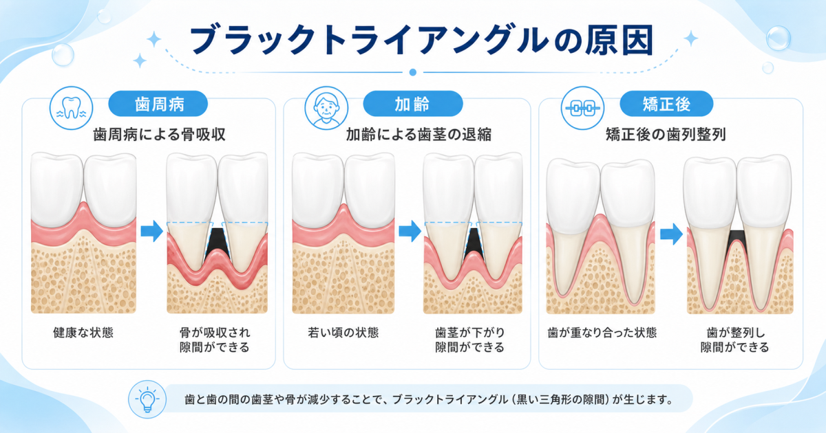 ■ブラックトライアングルが生じる原因は矯正だけではない